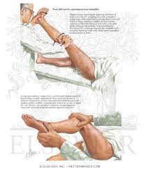 Image result for Pivot Shift Test