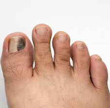 So am 15, and a girl, and sometimes, when i lay down for bed or am sitting, my body is normal but my tes fel incredibly cold, is there something wrong? Nail Problems Burbank Podiatrist Los Angeles Foot Ankle Center