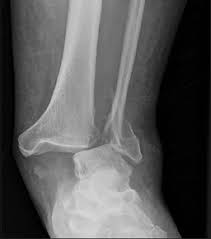 Image result for Ankle Dislocation