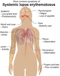 Learn about systemic lupus erythematosus from cleveland clinic, including treatment, diagnosis systemic lupus erythematosus, also called sle or lupus, is a disease of the immune system that. Systemic Lupus Erythematosus Physiopedia