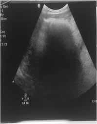 Image result for Bezoar