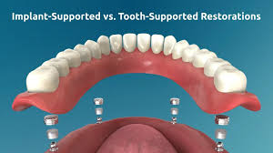 Implant-Supported vs. Tooth-Supported Restorations: Long-Term Biomecha