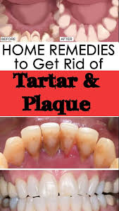 Home Remedies To Get Rid Of Tartar And Plaque Getinfopedia Com In 2020 Plaque Removal Homemade Remedies Healthy Smile