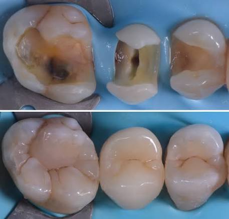 Same-day root canal New Brunswick