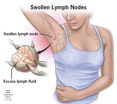 The parotid gland locates anterior to the outer ear, the submandibular gland is located below the oral. Swollen Lymph Nodes Lymphadenopathy