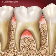 Gum Infection Around Tooth Roots Calls For Immediate Action Gillette Dental Pc