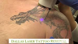 Picosure by cynosure is the most advanced laser technology for fast, safe, and effective removal of tattoos of all colors. Tattoo Removal Guaranteed Dallas Laser Tattoo Removal