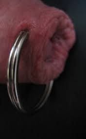 File:Closed ring piercing through glans penis and foreskin.jpg - Wikimedia  Commons