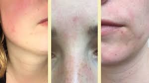 Bei den pickelmalen lassen sich atrophische und hypertrophische erscheinungsbilder unterscheiden. Microneedling Ich Habe Einen Dermaroller Zu Hause Getestet Stern De