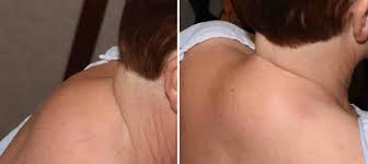 It's called a buffalo hump. Plastic Surgery Case Study Power Assisted Liposuction For Buffalo Hump Reduction Explore Plastic Surgery