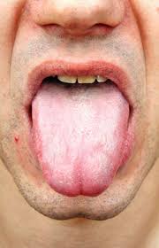 Lengua Bacteriana Enfermedad Infeccion En Un Hombre Fotos Retratos Imagenes Y Fotografia De Archivo Libres De Derecho Image 41197705