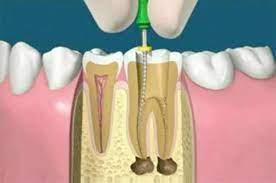 Discover what root canals cost at aspen dental. Root Canal Treatment Cm Dental Cinic Chiang Mai