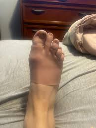 Image result for toe amputation