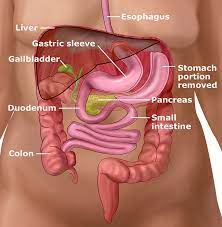 Gastric sleeve surgery is also known as vertical sleeve gastrectomy (vsg). Laparoscopic Sleeve Gastrectomy Gastric Sleeve