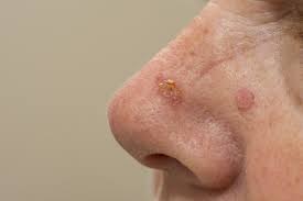 signs of cancer in dogs. Skin Cancer Treatment Options Mydr Com Au