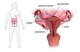 Endometriose is een gynaecologische aandoening waarbij cellen van het baarmoederslijmvlies (endometrium), die normaal de binnenkant van de baarmoeder bekleden. Cirurgia Para Endometriose Rr Medicos Cirurgioes