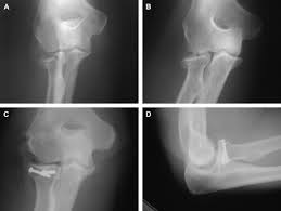 Radial Head Fractures Hand Clinics