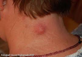 deri altinda sert kitle ve sislik neden olur