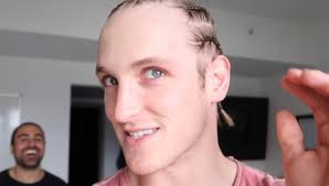 Forehead reduction surgery hairline lowering surgery before and after photos. Logan Paul Has A Bigger Forehead Than Ksi Ksi