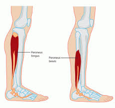 Beware The Flip Flop Aka Your Arch Rival Peroneus Longus Muscle Weakness Muscle Atrophy