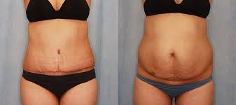 Aftercare and scar reduction by gaston tessada on april 13, 2020. Tummy Tuck Before After Gallery