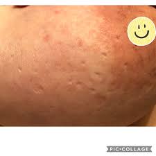 Breast cancer may not cause signs and symptoms, so this is one reason that screening mammograms are essential. Dimpled Breast October 2019 Babies Forums What To Expect