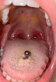 Yuck Help I M On Day 7 And Want To Know What S Wrong With It Pain Free And Can Eat What I Like Clean It Everyday And Mouthwash After Meals Is It Nesting