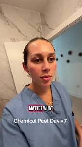 Chemical Peels for Dermititis