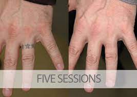 Again, depending on the size, location and type of tattoo being removed, you may need only a few sessions or several. Laser Tattoo Removal Results Gallery Eraditatt