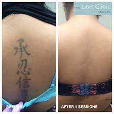 Before experimenting with any tattoo removal methods, you need a consultation with a cosmetic dermatologist, such as dr once your doctor has assessed your personal needs, he will be able to determine how many sessions will be needed to remove your tattoo. Tattoo Removal Treatment Laser