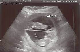 It is often not clear in the early weeks of a woman's pregnancy what type of twins she is carrying. 11 Weeks Pregnant With Twins Tips Advice How To Prep Twiniversity