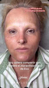 ✨ ¡La increíble transformación de Eva! ✨, Hoy quiero compartir con ustedes  el maravilloso caso de Eva. Eva vive con alopecia total y no tenía ningún  crecimiento natural en sus cejas. Utilizando la ...