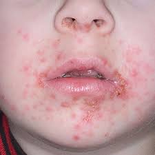 A face rash could be caused by many different things. Staph Skin Infection Healthdirect