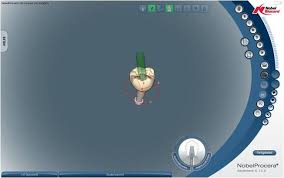 Ideal for patients with bruxism and parafunction who have destroyed other restorations. Immediate Implant Placement In The Molar Region With An Alternative Osteotomy Approach For Org