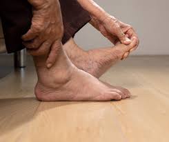 Image result for gout