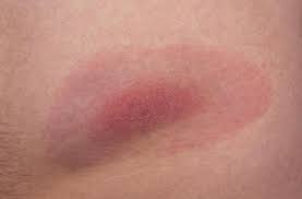 La maladie de lyme est classée dans les maladie rares, elle fait aussi partie des maladies que l'on appelle émergentes… le nom du test à faire pour dépister un lyme est un wb (western blot). Maladie De Lyme 300 Malades Portent Plainte Contre L Etat Et Contre La Science