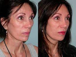 Apr 06, 2022 · before and after sculptra® aesthetic | lexington dermatology and laser center individual results and treatment sessions may vary. Sculptra Aesthetic Santa Rosa Cosmetic Surgery Artemedica