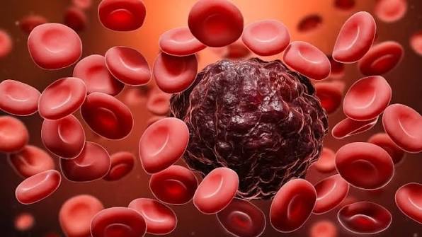 Bệnh ung thư máu: Dấu hiệu, triệu chứng và nguyên nhân là gì? | Genetica®