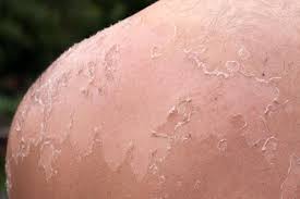 How to help my skin heal after a peeling? How Long Does Skin Peel After A Sunburn Skin Care Geeks