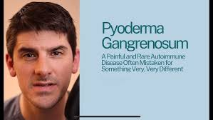 The Lived Experience of Having Pyoderma Gangrenosum