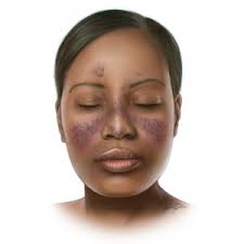 How to navigate the signs of lupus in the Black community –