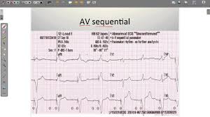 Pacemakers function based on timing cycles. Ecg Paced Rhythms Youtube