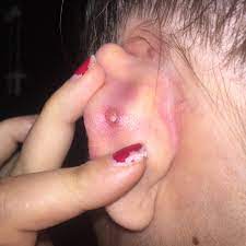 Bump On The Back Of My Ear Related To My Snug Piercing Happened After Taking The Jewelry Out And Putting It Back In When I Take It Out Now Sometimes Pus Or