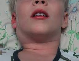 Uvelicheny Limfouzly Na Shee U Rebenka Prichiny Simptomy I Lechenie Gorodskaya Klinicheskaya Bolnica 1