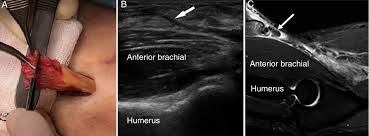 Image result for Biceps Tendon Injection