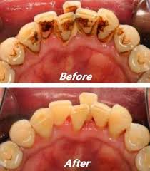 Here what we will do is pour two tablespoons of baking soda in a bowl along with two tablespoons of lemon and two of sea salt. Pin On Teeth Whitening