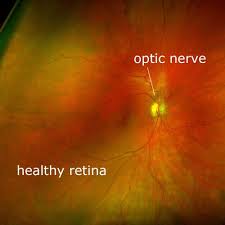 Optomap Retinal Image Normal Retina World Sight Day Eye Health Educational Technology