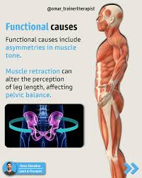 Image result for Functional Leg Length Discrepancy