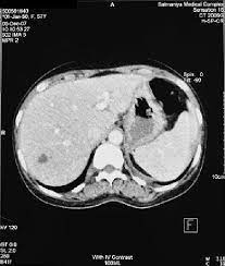 Ct Scan Of Abdomen Revealed 1 5 Cm Hypodense Lesion In Right Hepatic Download Scientific Diagram