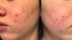 Much like vitamin c, vitamin e is an antioxidant and therefore reduces the number of free radical molecules floating due to these results, people with acne can safely use vitamin a supplements to combat their acne, especially if they already have a vitamin a deficiency. Did Vitamin B12 Give Me Acne Mixed Makeup